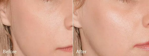 CHEEK ENHANCEMENT TREATMENT