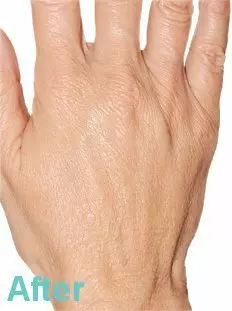 Hand Rejuvenation Treatment