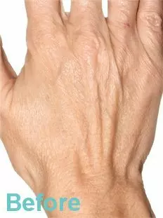 Hand Rejuvenation Treatment