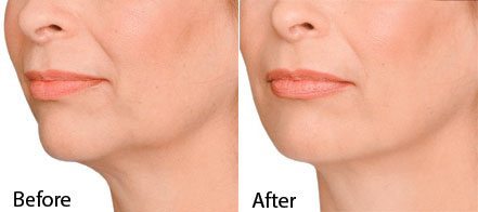 Jaw-line treatment-before and after photo