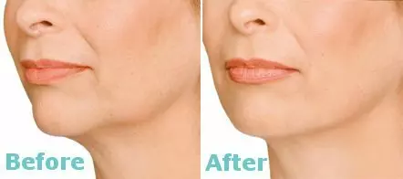 JOWLS AND LOWER JAW LINE CONTOURING RESULTS