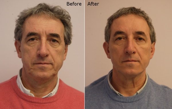 Silhouette soft thread lift in a male patient-before and after