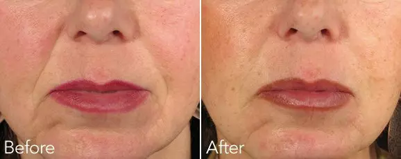 MARIONETTE LINES BOTOX TREATMENT BEFORE & AFTER RESULTS