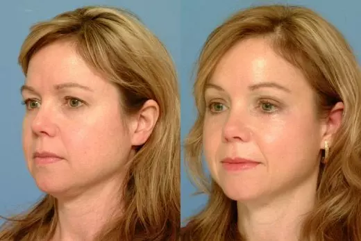 Botox Eyebrow Lift Treatment before and after Results