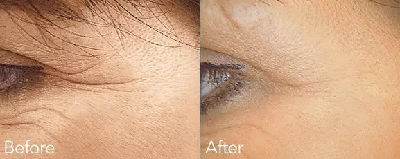 DERMAL FILLER SMILE LINES TREATMENT