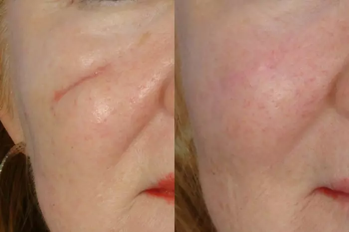 DERMAL FILLER SCARS TREATMENT RESULTS