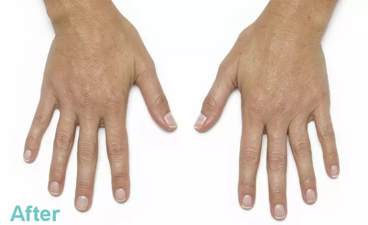 HAND REJUVENATION WITH PLATELET RICH PLASMA RESULTS