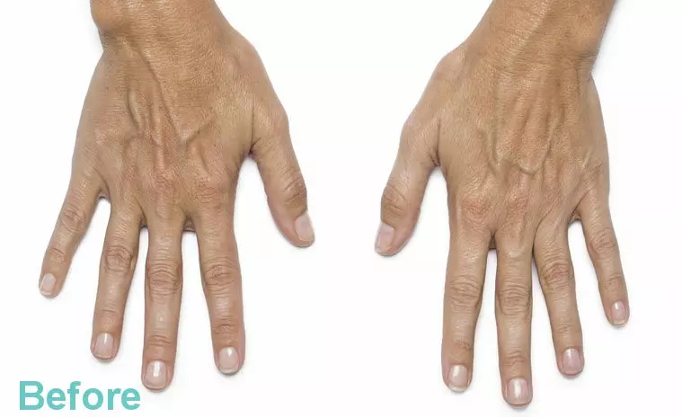 Hand Rejuvenation Treatment