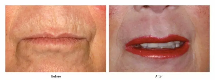 upper lip barcode lines treatment-before and after photo