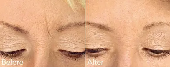 FROWN LINE DERMAL FILLER TREATMENT