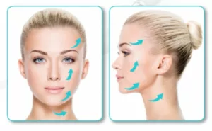 Diary Of A Silhouette Soft Lift Treatment Patient | Excellence Medical Clinic Silhouette Soft thread lift-before and after