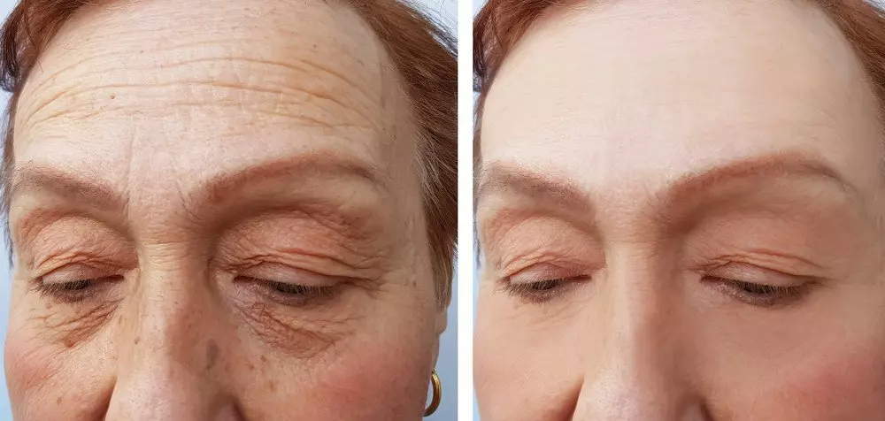 Horizontal Frown Lines Botox Treatment