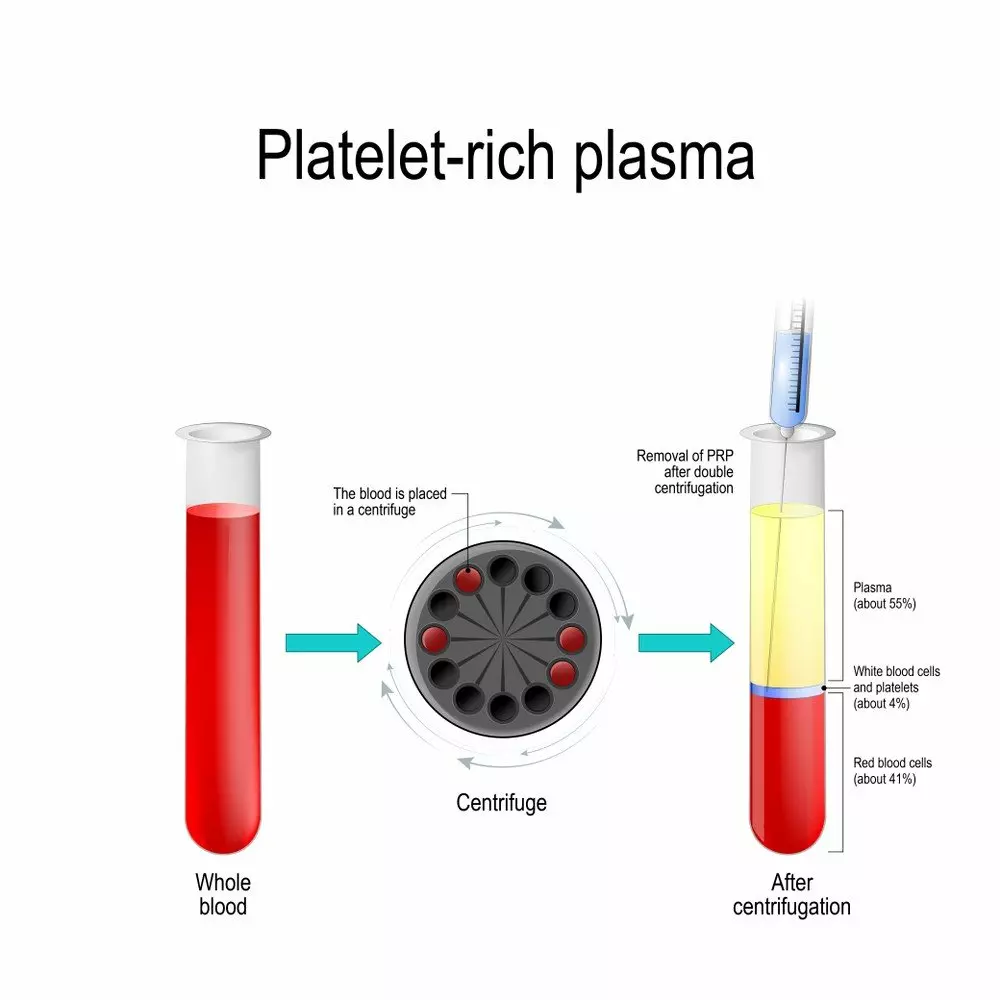 Platelet Rich Plasma - PRP Treatment