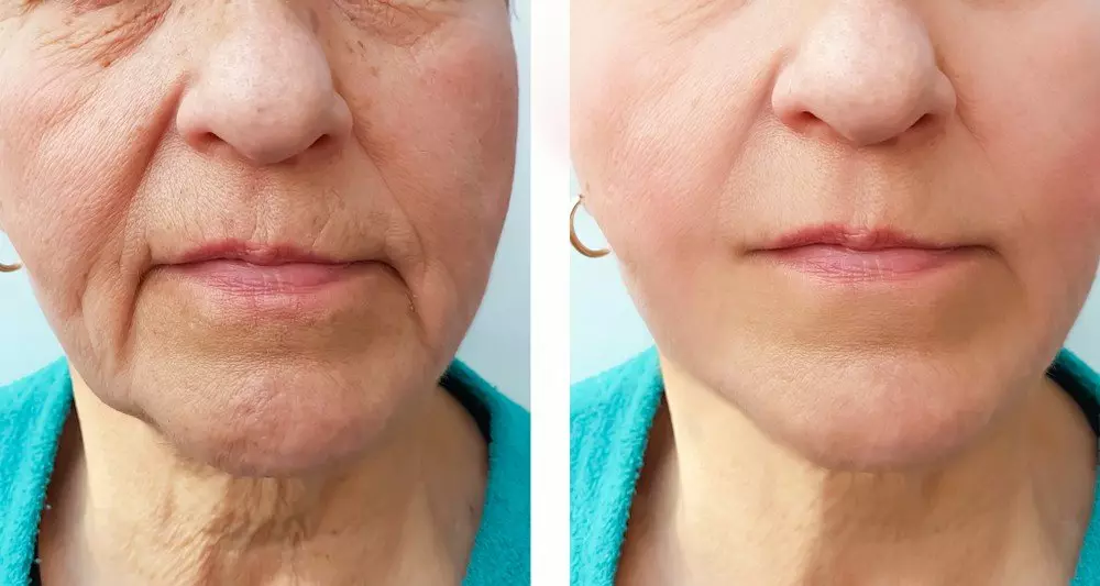 MARIONETTE LINES BOTOX TREATMENT BEFORE & AFTER RESULTS