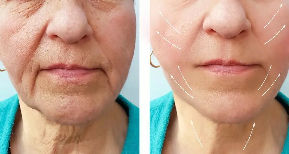 Facial remodelling for rounded and square shape face to gently elongated shape