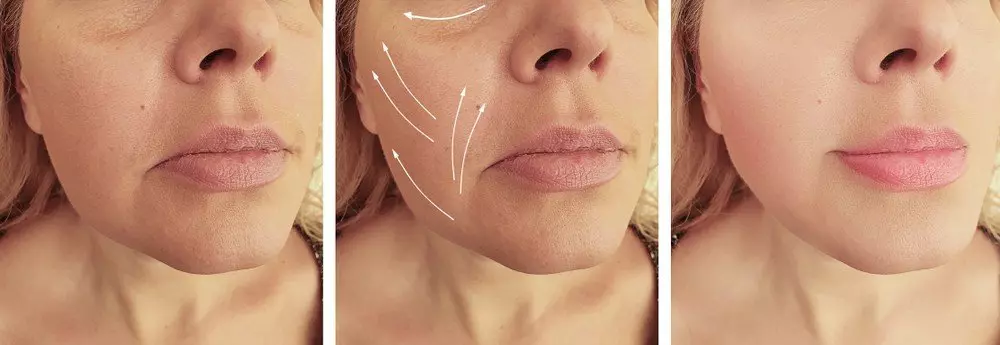 Facial remodelling for rounded and square shape face to gently elongated shape