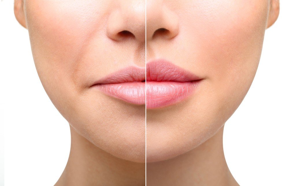 Mouth to Lip Lines Dermal Filler Treatment