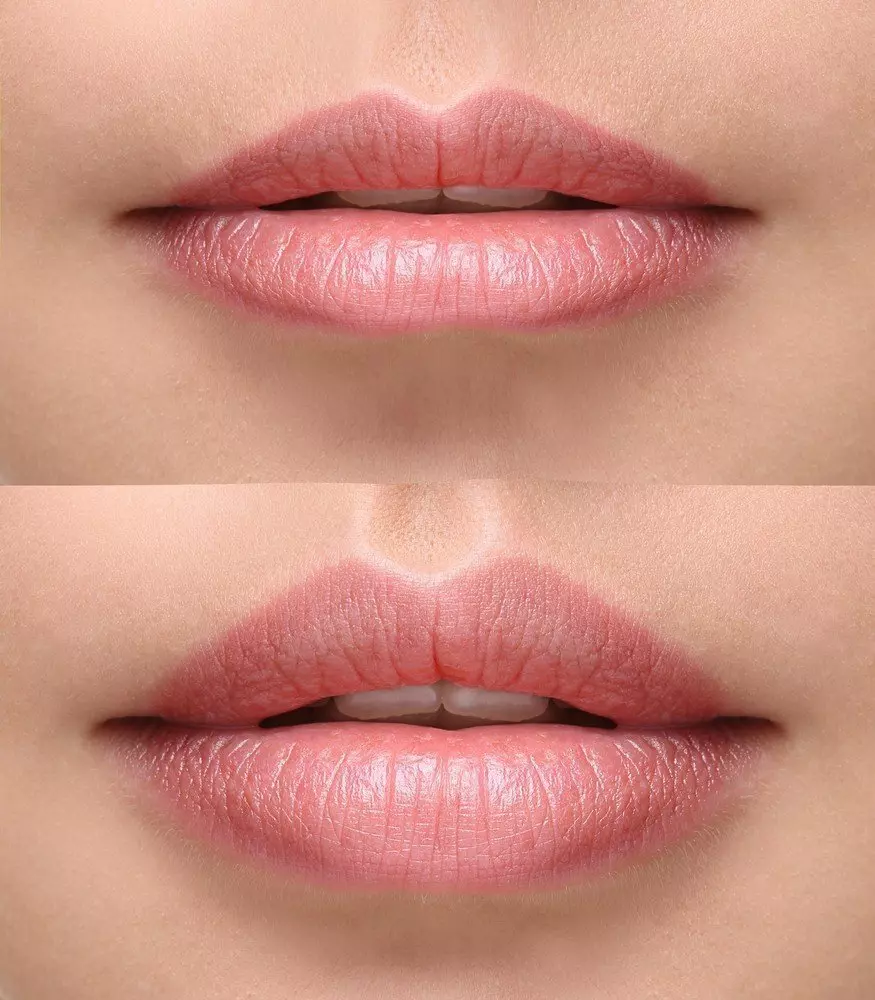 Lip rejuvenation with Dermal Filler- great before and after photo