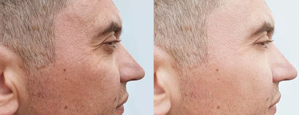 Dermal Filler Smile Lines Treatment