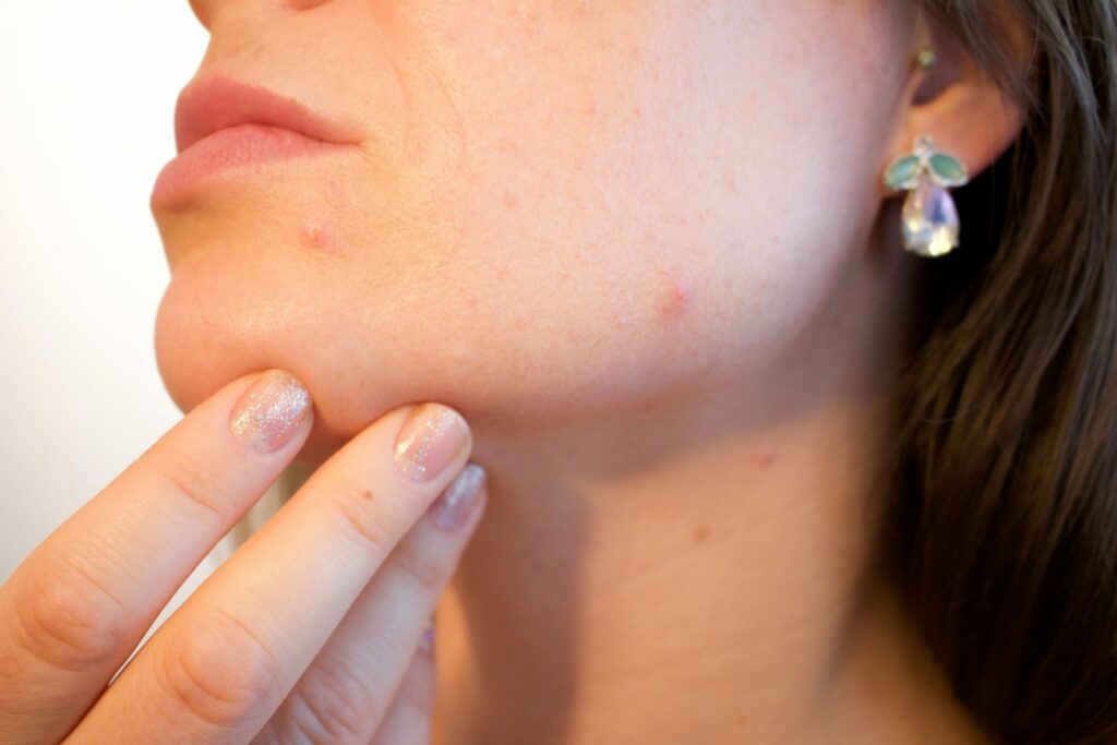 Acne and Acne Scarring Treatments