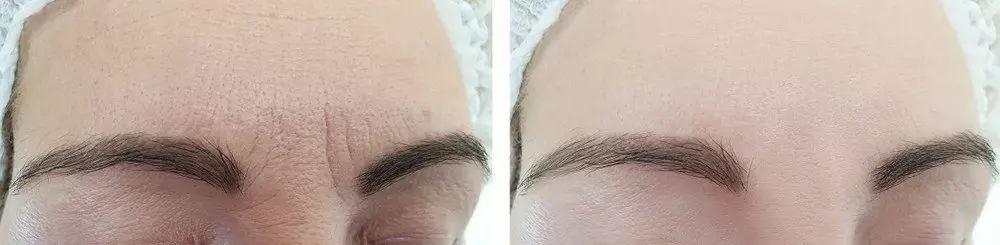 Deep Frown Lines treatment