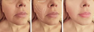 7 Advantages To Have A Silhouette Soft Lift Treatment | Excellence Medical Clinic Silhouette Soft lift of face-before and after photos