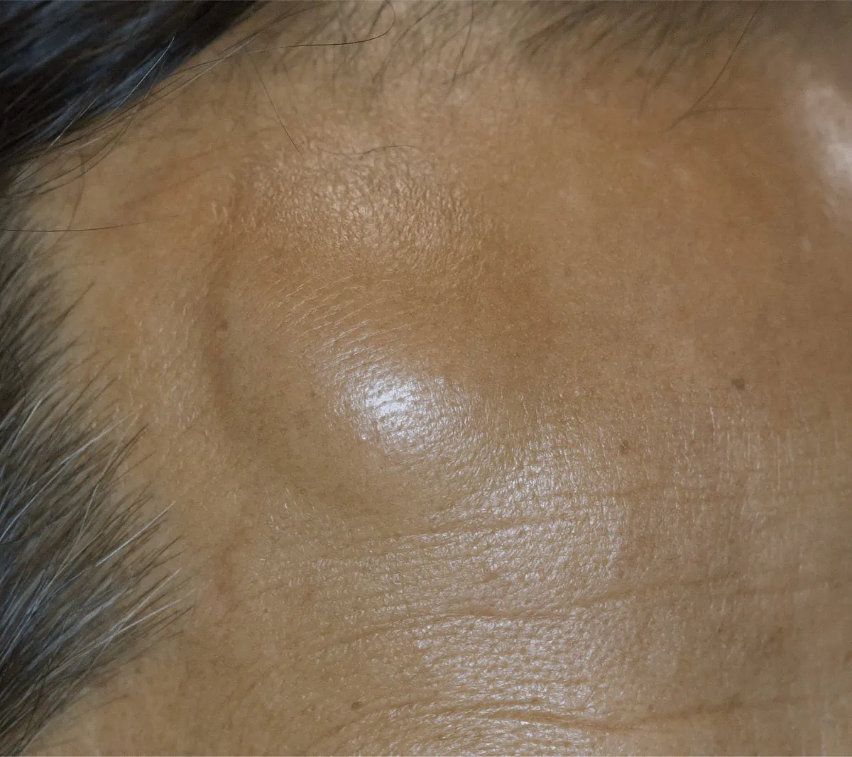 Sebacous Cyst on forehead