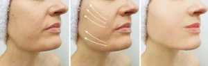 Diary Of A Silhouette Soft Lift Treatment Patient | Excellence Medical Clinic Lifting of saggy skin