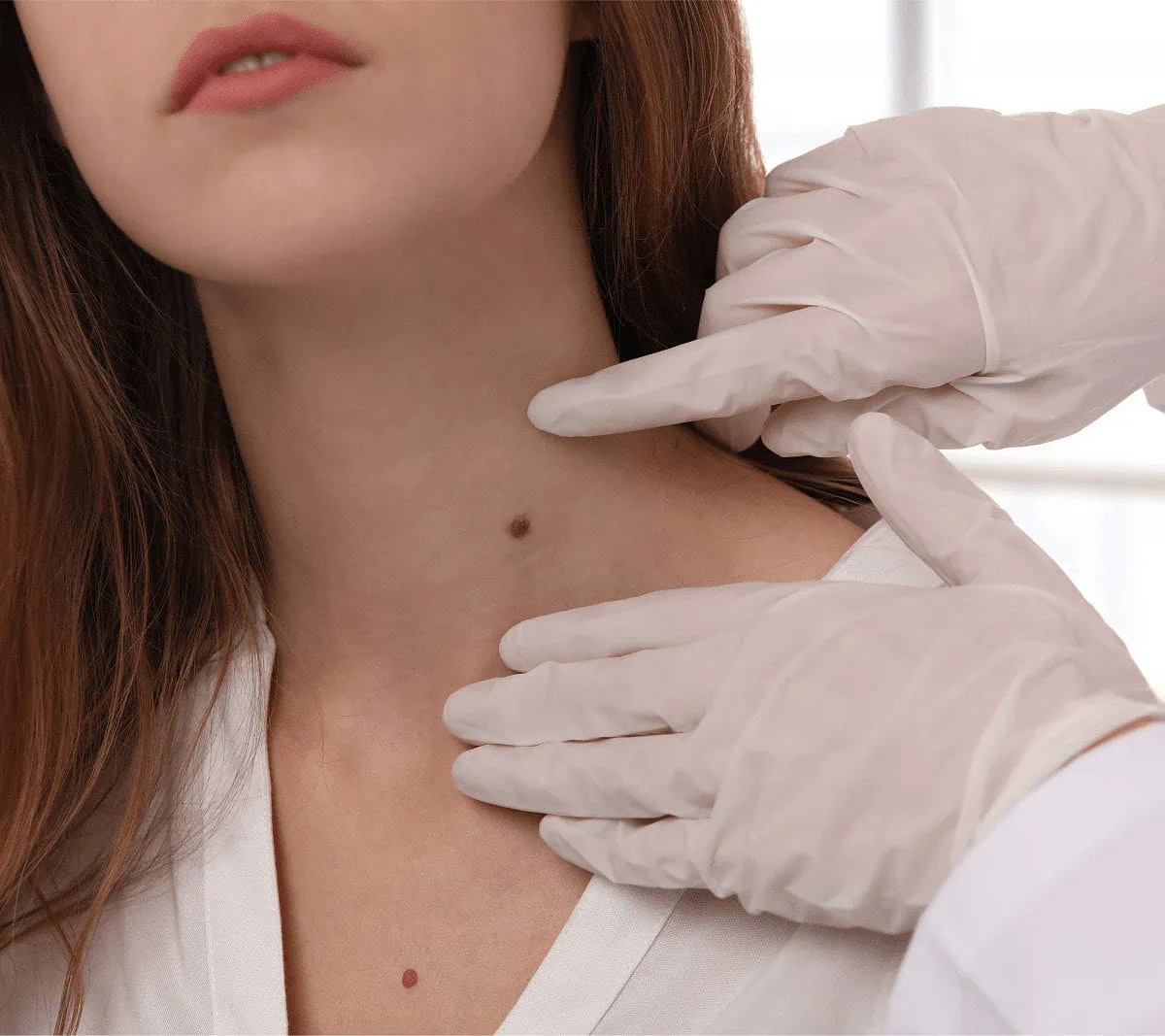 Mole-on-the-neck-for-removal