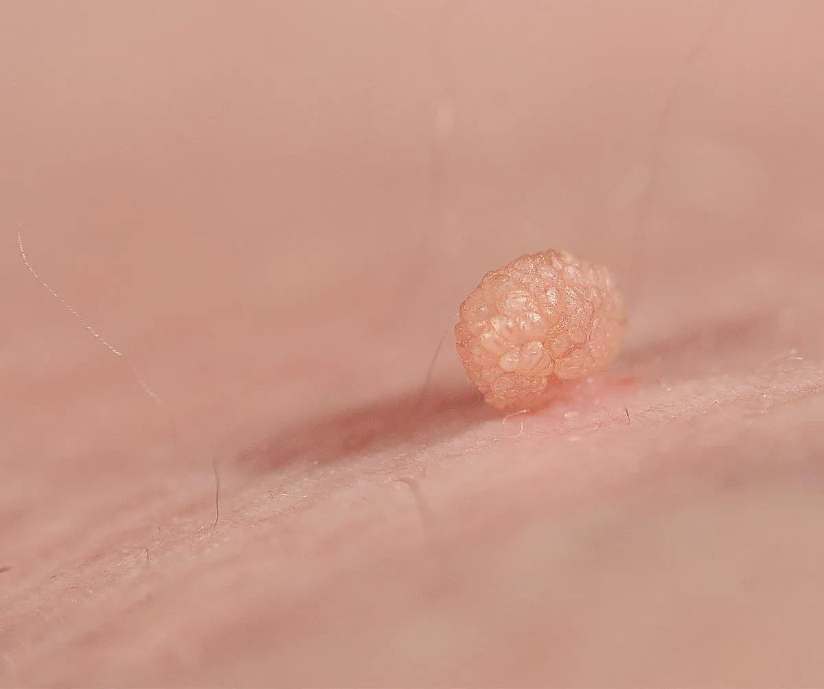 Skin Tag Removal Treatment