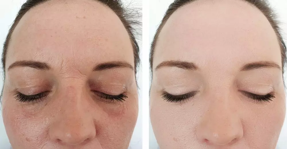 Deep Frown Lines treatment