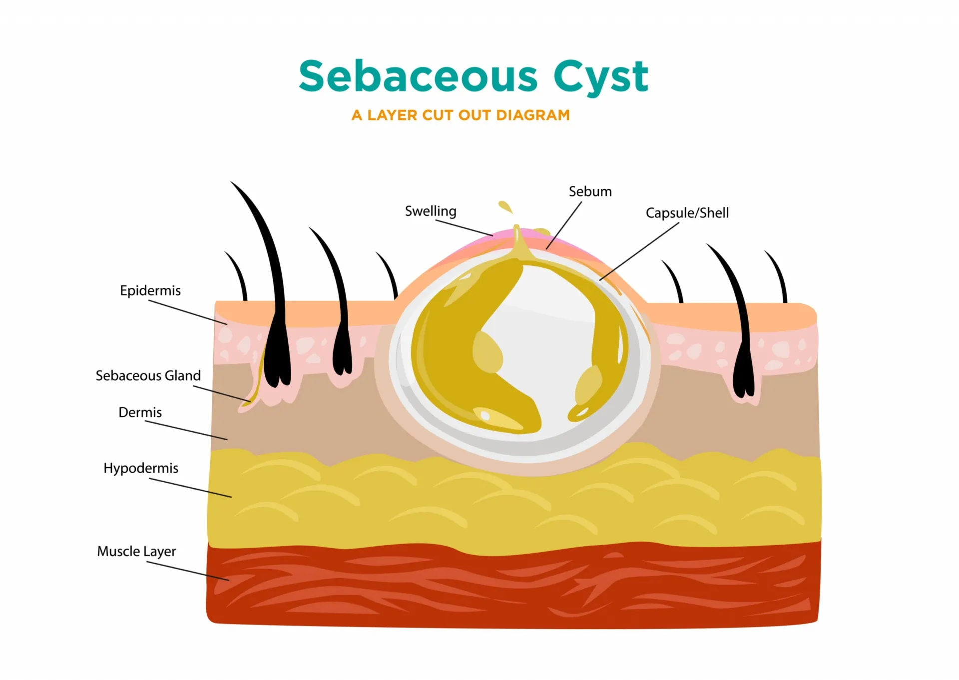 Sebaceous-Cyst-illustrated