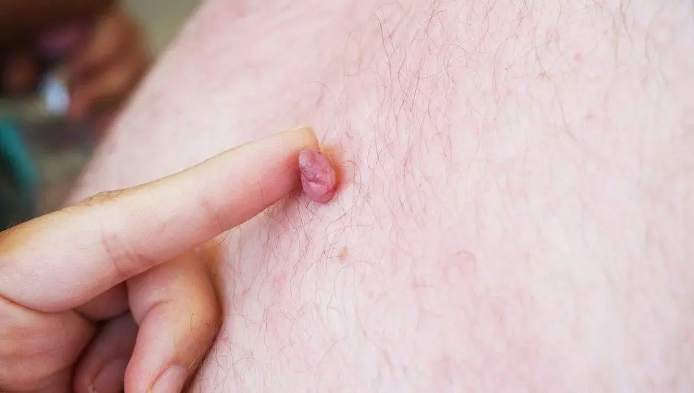 Skin Tag Removal Treatment